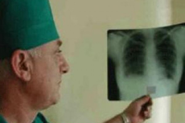 В Беларуси растет уровень распространения мультирезистентных форм туберкулеза